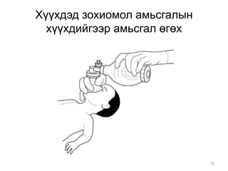 26
Хүүхдэд зохиомол амьсгалын
хүүхдийгээр амьсгал өгөх
 