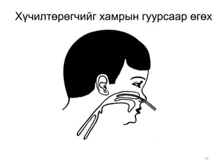 31
Хүчилтөрөгчийг хамрын гуурсаар өгөх
 