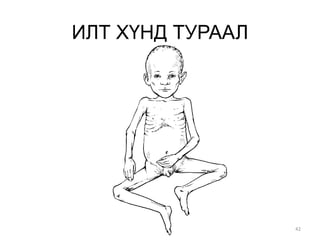 42
ИЛТ ХҮНД ТУРААЛ
 