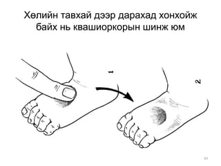 43
Хөлийн тавхай дээр дарахад хонхойж
байх нь квашиоркорын шинж юм
 