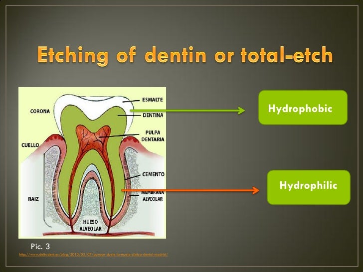 Etchant in dentistry