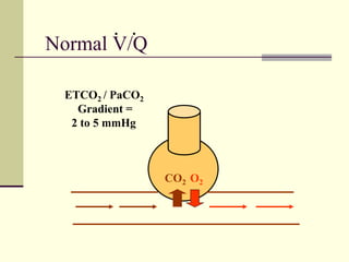 Normal V/Q
CO2 O2
ETCO2 / PaCO2
Gradient =
2 to 5 mmHg
. .
 