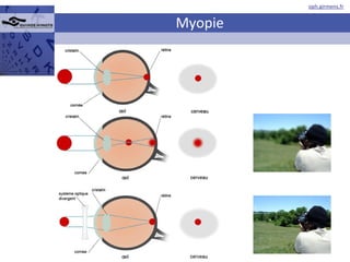 Myopie 