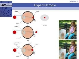 Hypermétropie 