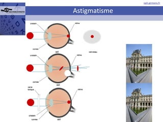 Astigmatisme 