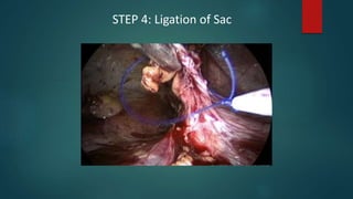 STEP 4: Ligation of Sac
 
