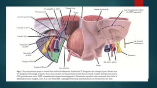 EXTENDED TOTALLY EXTRA PERITONEAL REPAIR eTEP PPTX EXTENDED TOTALLY EXTRA PERITONEAL REPAIR eTEP PPTX