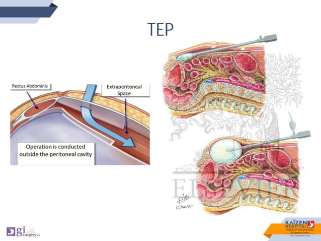 ETEP for Inguinal Hernias Dr Sanjiv Haribhakti www gisurgery info 1 ETEP for Inguinal Hernias Dr Sanjiv Haribhakti www gisurgery info 1