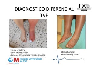 DIAGNOSTICO DIFERENCIAL 
              TVP 




Edema unilateral 
Dolor y tumefacción                     Edema bilateral 
Aumento temperatura y enrojecimiento    Tumefacción y dolor 
 