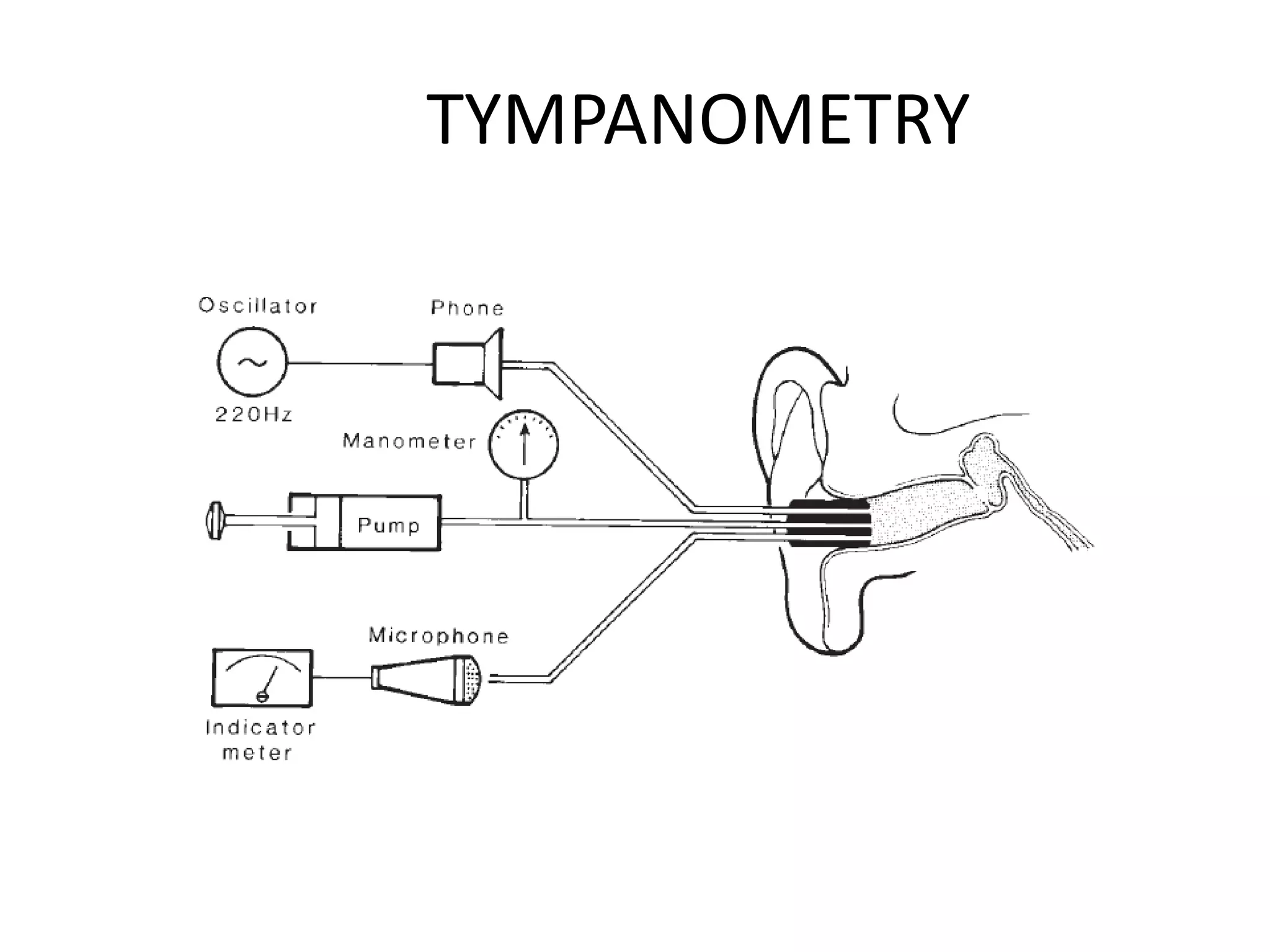 TYMPANOMETRY
 