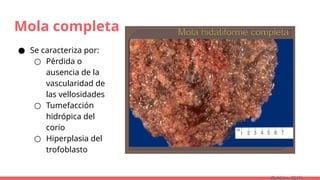 Mola completa
● Se caracteriza por:
○ Pérdida o
ausencia de la
vascularidad de
las vellosidades
○ Tumefacción
hidrópica del
corio
○ Hiperplasia del
trofoblasto
(Robbins, 2015)
 