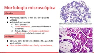 Morfología microscópica
● Anomalías afectan a todo o casi todo el tejido
vellosos
● Vellosidades coriónicas:
○ Son + grandes
○ Forma festoneada con una cavidad central
(cisternas)
○ Recubiertas por proliferación extensa de
trofoblastos (toda la circunferencia)
ns, 2015)
Completa
Incompleta
● Solo una parte de las vellosidades está agrandada
y edematosa
● Hiperplasia trofoblástica es focal y menos intensa
 