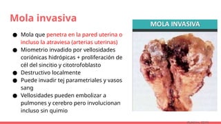 Mola invasiva
● Mola que penetra en la pared uterina o
incluso la atraviesa (arterias uterinas)
● Miometrio invadido por vellosidades
coriónicas hidrópicas + proliferación de
cél del sincitio y citotrofoblasto
● Destructivo localmente
● Puede invadir tej parametriales y vasos
sang
● Vellosidades pueden embolizar a
pulmones y cerebro pero involucionan
incluso sin quimio
(Robbins, 2015)
 