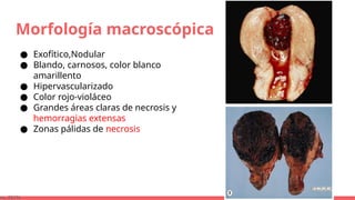Morfología macroscópica
● Exofítico,Nodular
● Blando, carnosos, color blanco
amarillento
● Hipervascularizado
● Color rojo-violáceo
● Grandes áreas claras de necrosis y
hemorragias extensas
● Zonas pálidas de necrosis
ns, 2015)
 
