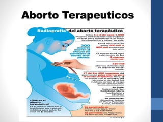Aborto Terapeuticos 
 