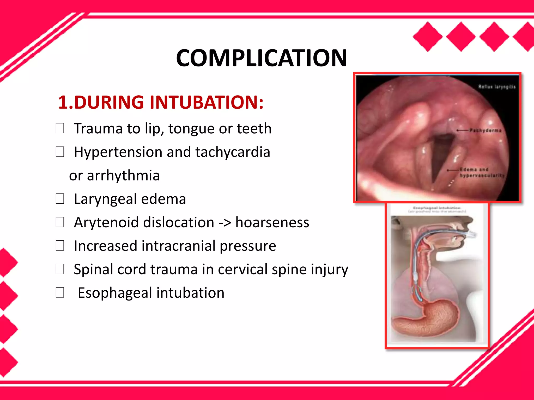 Endotracheal intubation | PPTX