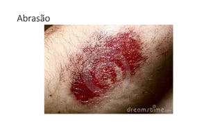 Abrasão
 