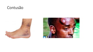 Contusão
 