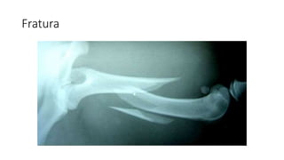 Fratura
 