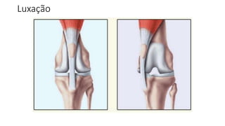 Luxação
 