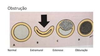 Obstrução
Normal Extramural Estenose Obturação
 