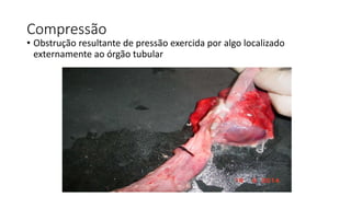 Compressão
• Obstrução resultante de pressão exercida por algo localizado
externamente ao órgão tubular
 