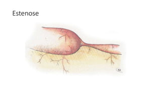 Estenose
 