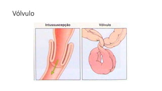 Vólvulo
 