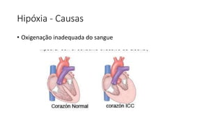 Hipóxia - Causas
• Oxigenação inadequada do sangue
 