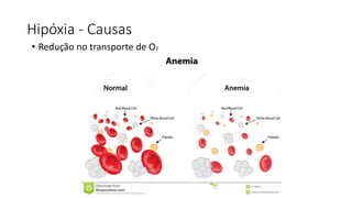 Hipóxia - Causas
• Redução no transporte de O2
 