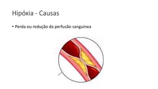 Hipóxia - Causas
• Perda ou redução da perfusão sanguínea
 