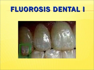 FLUOROSIS DENTAL I 