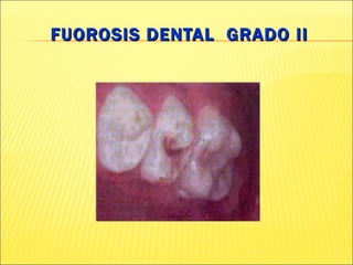 FUOROSIS DENTAL  GRADO II 