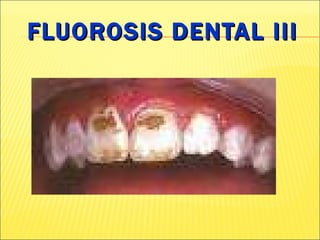 FLUOROSIS DENTAL III 