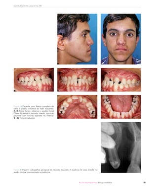 Garib DG, Silva OG Filho, Janson G, Pinto JHN




                                                 A                                                       B




C                                                D                                                       E




Figura 4 Paciente com fissura completa de
lábio e palato unilateral do lado esquerdo.
A, B) Fotos faciais: observar o padrão facial
Classe III devido à retrusão maxilar típica do
paciente com fissuras operado na infância.
C a G) Fotos intrabucais.                        F                                                       G




Figura 5 Imagem radiográfica periapical do rebordo fissurado. A ausência de osso alveolar na
região limita a movimentação ortodôntica.




                                                                       Rev Clín Ortod Dental Press. 2010 ago-set;9(4):30-6   35
 