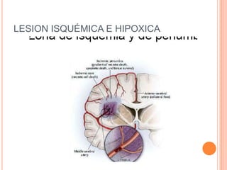 LESION ISQUÉMICA E HIPOXICA
 