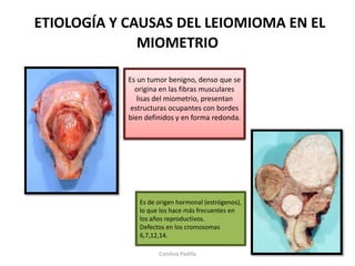 Etiologia del leiomioma en el miometrio | PPTX