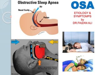 OSA
ETIOLOGY &
SYMPTOMPS
by
DR.FAIZAN ALI
 