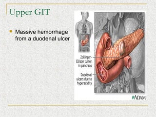 Upper GIT
   Massive hemorrhage
    from a duodenal ulcer
 