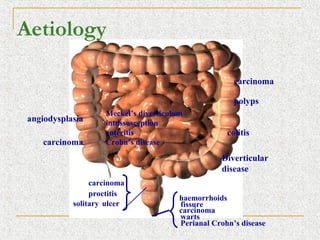 Aetiology

                                                       carcinoma

                                                       polyps
                    Meckel’s diverticulum
 angiodysplasia     intussusception
                    enteritis                        colitis
    carcinoma       Crohn’s disease

                                                   Diverticular
                                                   disease
                 carcinoma
                 proctitis
                                        haemorrhoids
            solitary ulcer              fissure
                                        carcinoma
                                        warts
                                        Perianal Crohn’s disease
 