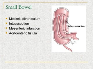 Small Bowel
   Meckels diverticulum
   Intussception
   Mesenteric infarction
   Aortoenteric fistula
 