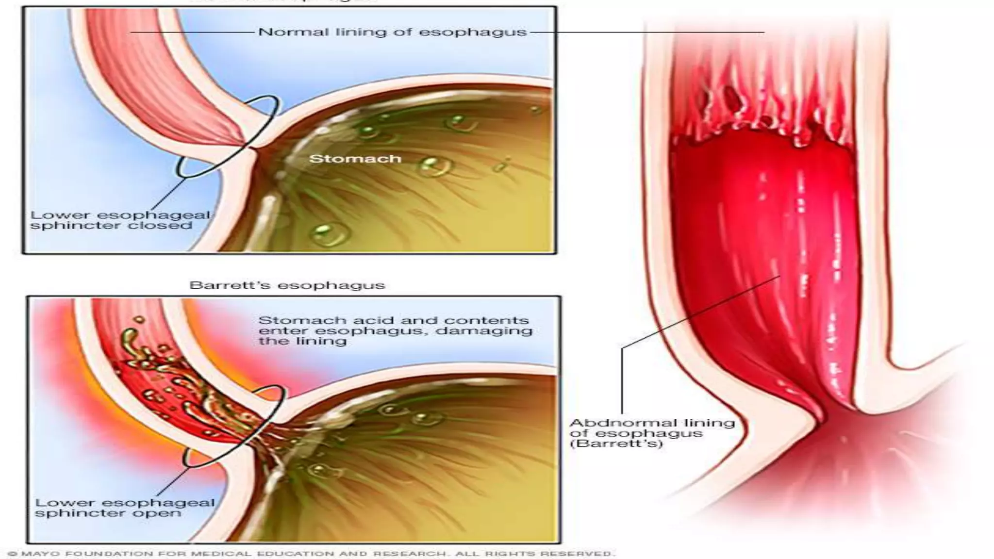 Barret Esofagitis Etiology , morphology & pathogenesis of barret’s esophagus | PPTX