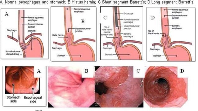 Barret Esofagitis Etiology , morphology & pathogenesis of barret’s esophagus | PPTX ...