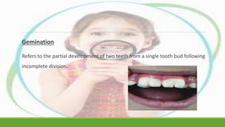 Etiology of malocclusion | PPTX