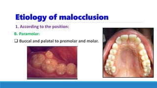 Etiology of malocclusion