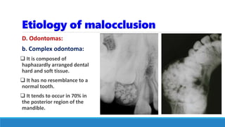 Etiology of malocclusion