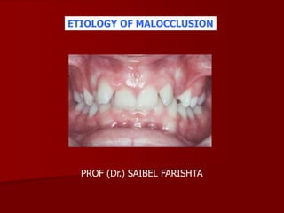 ETIOLOGY OF MALOCCLUSION
PROF (Dr.) SAIBEL FARISHTA
 