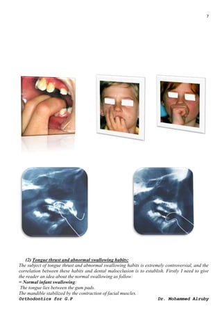 7
Dr. Mohammed Alruby
Orthodontics for G.P
(2) Tongue thrust and abnormal swallowing habits:
The subject of tongue thrust ...