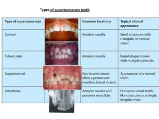Types: Conical, tuberculate, supplemental & odontomes




An erupted mesiodens causing separation of
the upper central inc...
