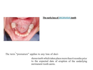 • Causes of Premature Loss



i. Extensive carious lesion.
ii. Accidents "trauma" lead to loss of the
tooth vitality and a...
